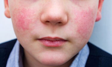 Example of Parvovirus-B19's affect on the cheeks. "Slapped Cheek Rash".