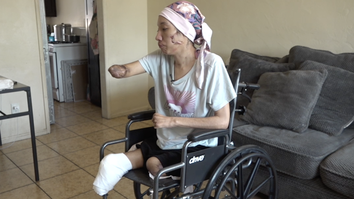 <i>KGTV via CNN Newsource</i><br/>Arisbeth Munoz is now home after a harrowing battle with necrotizing fasciitis that led to multiple amputations.